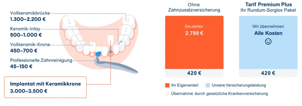 Da-Direkt-Zahnzusatzversicherung-Leistungen